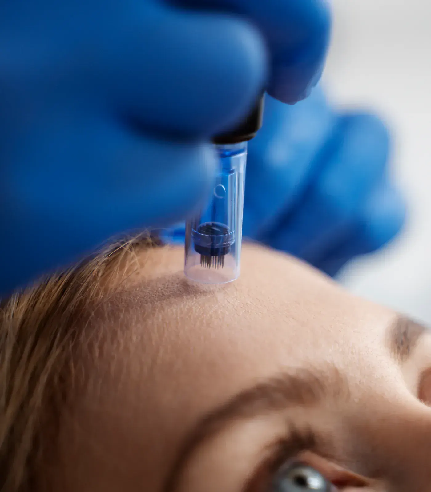 Procédure professionnelle de microneedling sur le front à Trois-Rivières